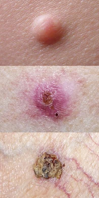 <p>basal cell carcinoma</p>