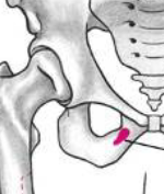 <p>front of inferior pubic ramus </p>