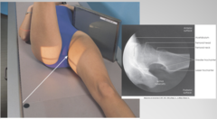 <p>SID: 40in</p><p>kVp: 70-90</p><p>Grid: Yes</p><p>CR: perpendicular to femoral neck and IR (IR and CR at 45° in the crotch)</p><p>Patient position: Patient supine, Elevate pelvis 1 to 2 inches if possible, Flex & elevate unaffected leg, internally rotate affected like 15 unless possible hip fracture</p><p>Breathing instructions: suspend respiration during exposure</p><p>Evaluation criteria: Entire femoral head and neck, trochanter and acetabulum as well as any orthopedic device</p>