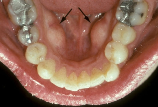 <p>outgrowths of normal dense bone found on the lingual aspect of the mandible premolars are</p>