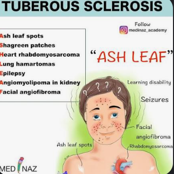 <p>tuberous sclerosis complex → associated with cardiac rhabdomyoma (causing the murmur) and renal angiomyolipoma (look at pic for mnemonic)</p>