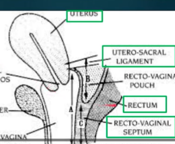 <p>Beginning with position and orientation of the uterus (ensuring it is anteverted and not retroverted = associated with severe disease states). Then rectovaginal examination, palpating uterosacral ligaments and recto-vaginal septum; tender nodes here indicate deeply infiltrating endometriosis. Adnexal masses may also be detected (growths along reproductive tract), such as endometriomas = specific adnexal masses growing on ovaries. Can be done at any time, but liklihood of detection is increased during the menstruation phase. </p>