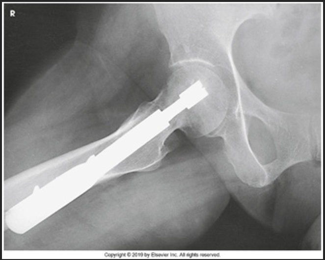 <p>If this is a lateral projection of the hip, how many degrees is the leg abducted</p>