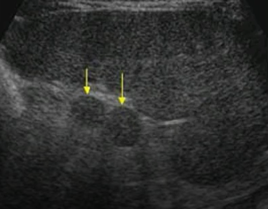 <p>Describe an accessory spleen.</p>