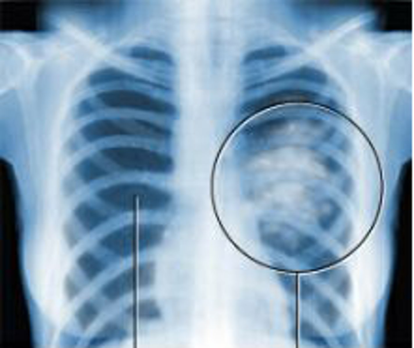 <p>/ˈkæn.sər/ - bệnh ung thư - regular medical checkups can help detect signs of cancer at an early stage</p>