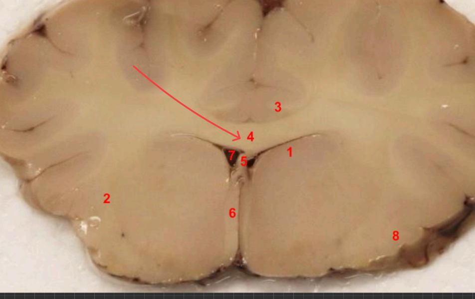 <p>what commisure is this </p>