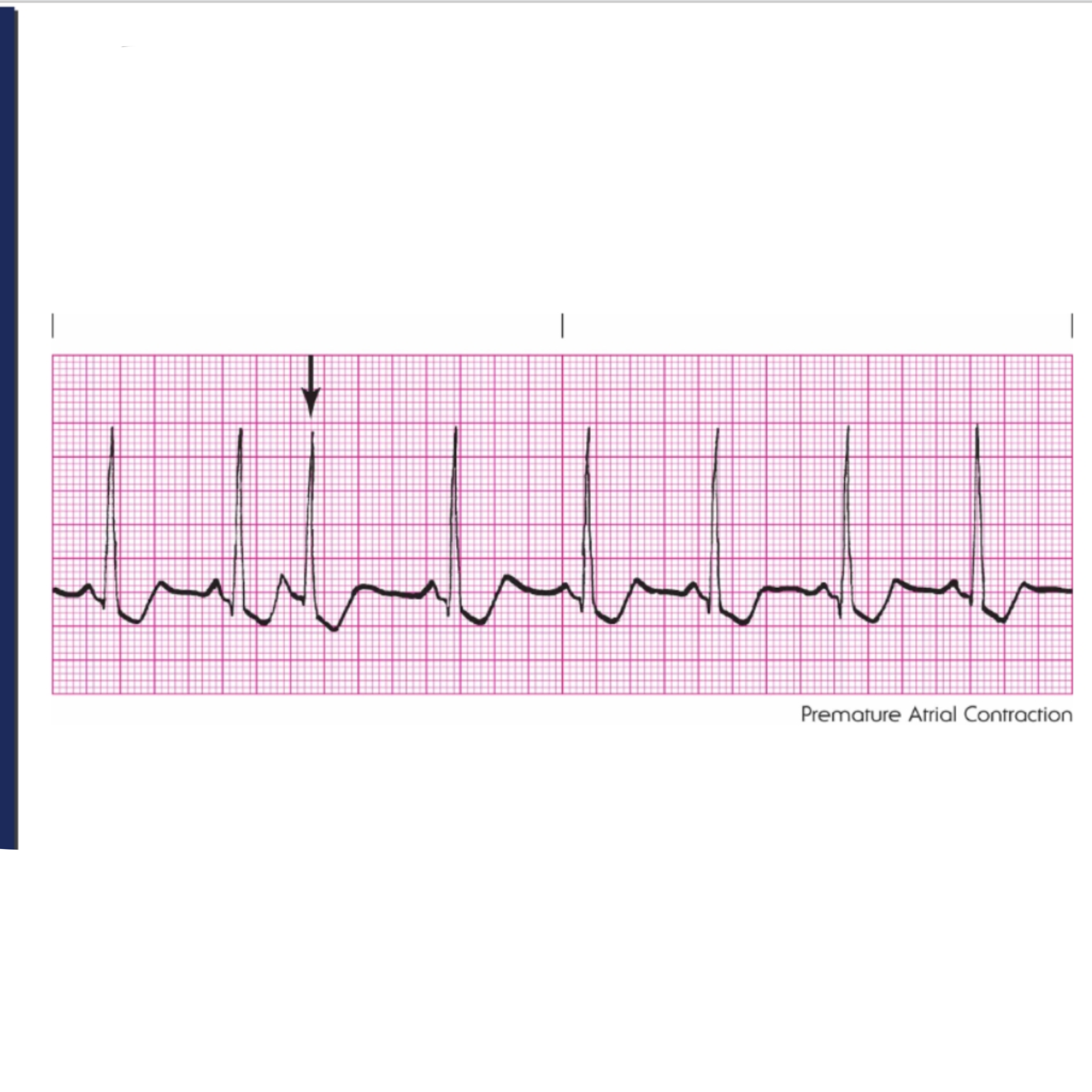 <p>Rules for Premature Atrial Complex are </p>
