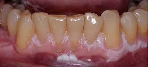 <p>CASE: An older woman who does not use tobacco develops multiple rough, spreading keratotic plaques involving the gingiva and other oral sites. The plaques recur and continue to enlarge despite several biopsies and excisions. What is the most likely diagnosis?</p>