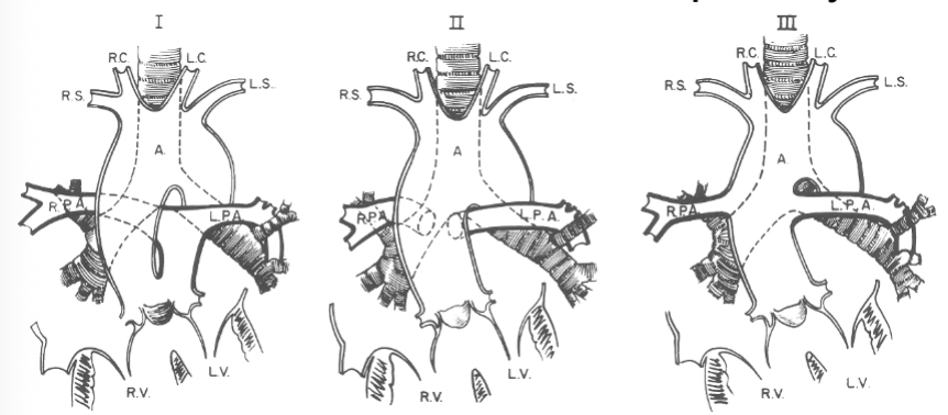<ul><li><p>1 - PA arises from truncus + shares common valve annulus</p></li><li><p>2 + 3 - PA branches arise separately</p></li></ul><p></p>