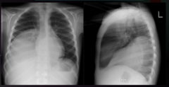 <p>What is the imaging imaging modality that would best characterize this finding/condition? </p><p>a. No further imaging needed </p><p>b. CT with contrast </p><p>c. Bone scan </p><p>d. US with contrast</p>
