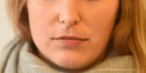 <p>Lip Funneler</p>