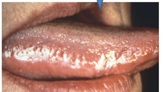 <p>1.what is this lesion?</p><p>2. how to treat/ manage it?</p><p>3. classification of oral lesion in HIV?</p>