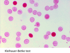 <p>Quantitative test to determine the percent of fetal cells in the mother's blood. Determines how much Rhogam to administer. </p><p>Acid elution knocks off hemoglobin, but not the fetal hemoglobin and is stained so that fetal cells retain stain. Fetal cells stain a *darker red/hot pink color*, while maternal cells stain a lighter, white-ish pink.</p>