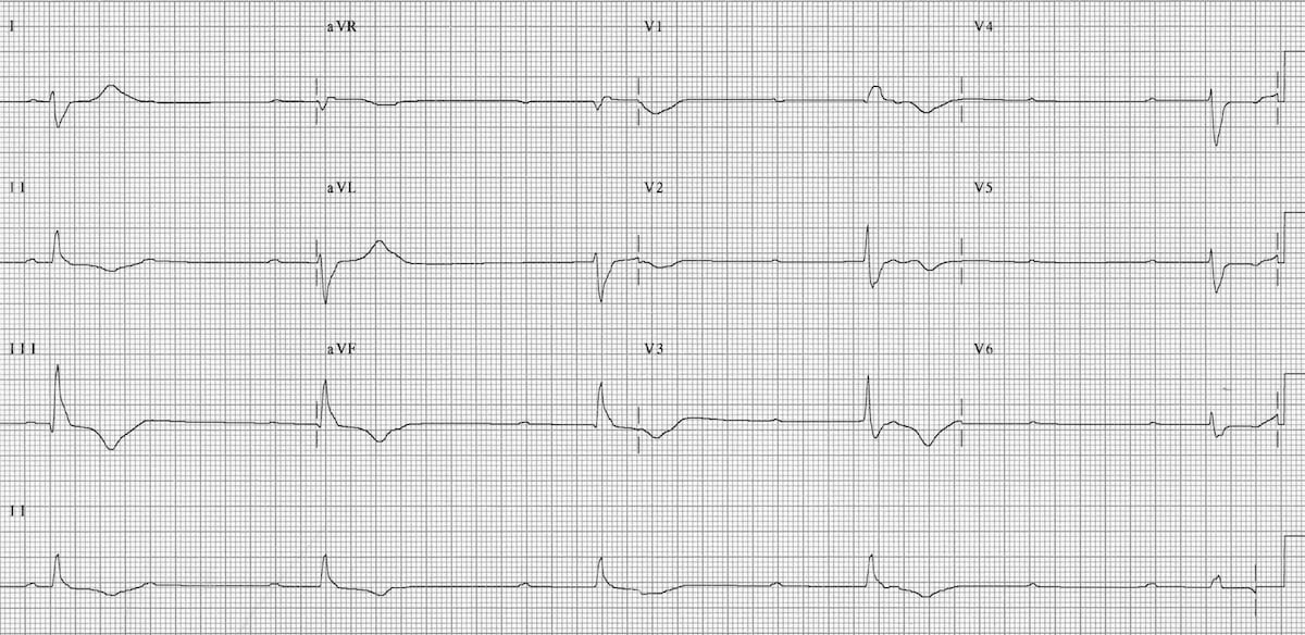 <p>What does this EKG show?</p>