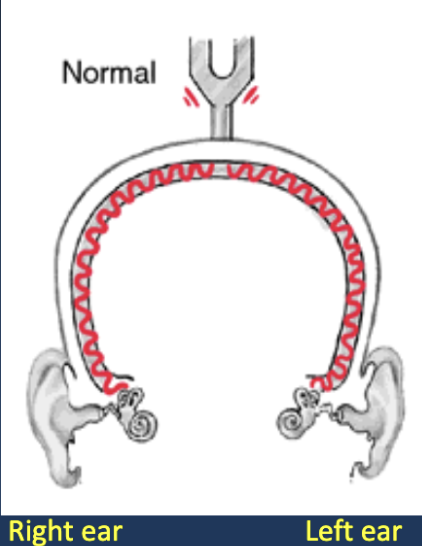 <ul><li><p>No unilateral hearing loss </p><ul><li><p>Caveat: This could mean either normal hearing or bilateral sensorineural hearing loss</p></li></ul></li></ul><p></p>