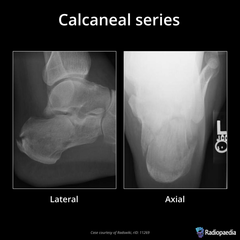 <p>Routine projections of the calcaneus?</p>