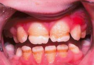 <p>most <span style="color: red;">common hereditary</span> enamel phenotype</p><p>defect involving the <span style="color: red;">amount (quantity) of enamel formed</span></p>