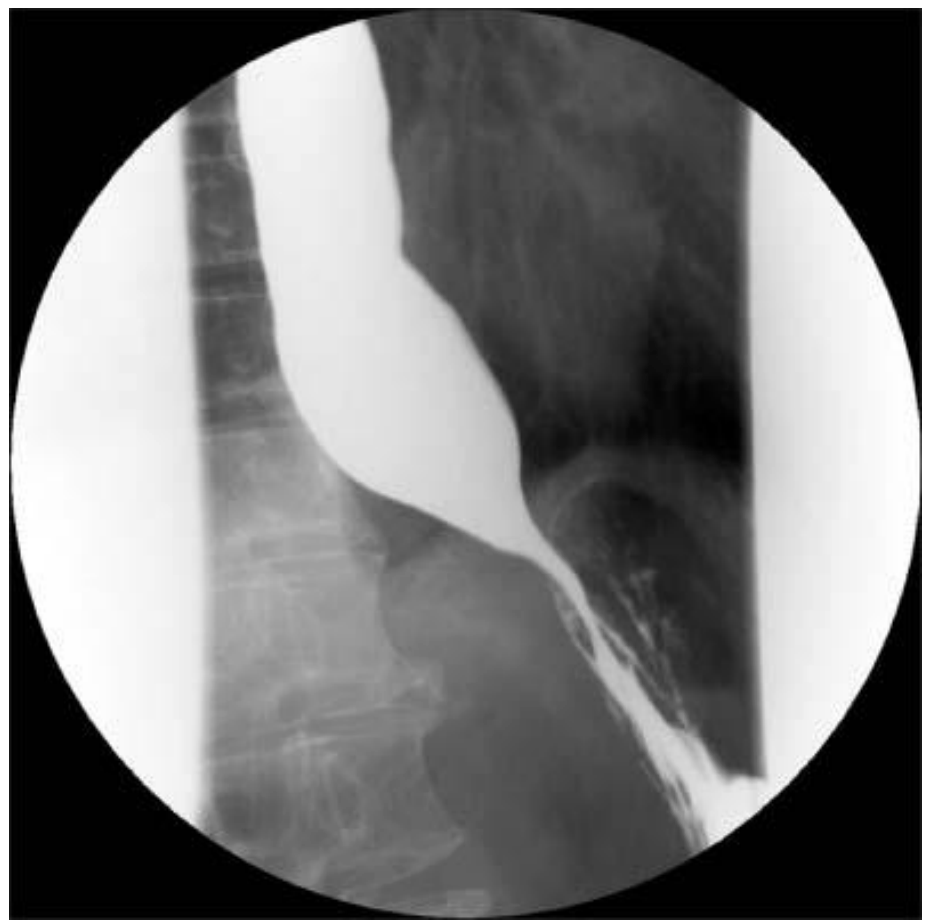 <p>bird’s beak sign seen in </p>