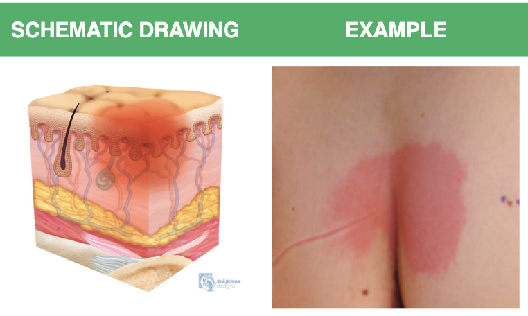 <p>Non-blanchable erythema of <em>intact</em> skin</p>