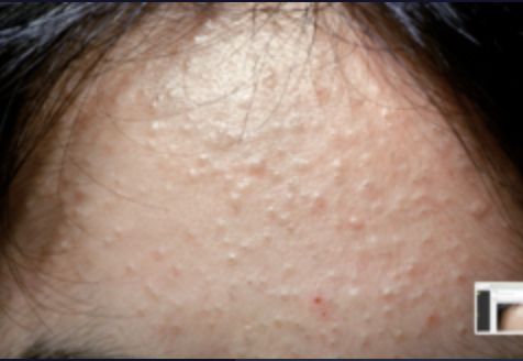 <p>Paciente femenino de 17 años, sana. Acude a consultar porque ha notado cambios en la textura de su piel. A la exploración física, encontramos la dermatosis que se observa en la fotografía. ¿Qué tratamiento indicaría en esta paciente?</p>