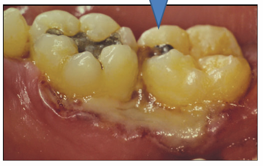 <p>1.what is this lesion?</p><p>2. how to treat/ manage it?</p><p>3. classification of oral lesion in HIV?</p>