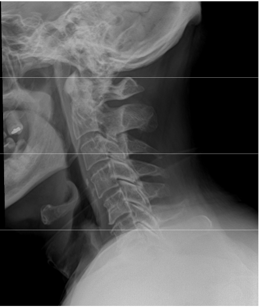 <p>Fix this image (Lateral Cervical)</p>