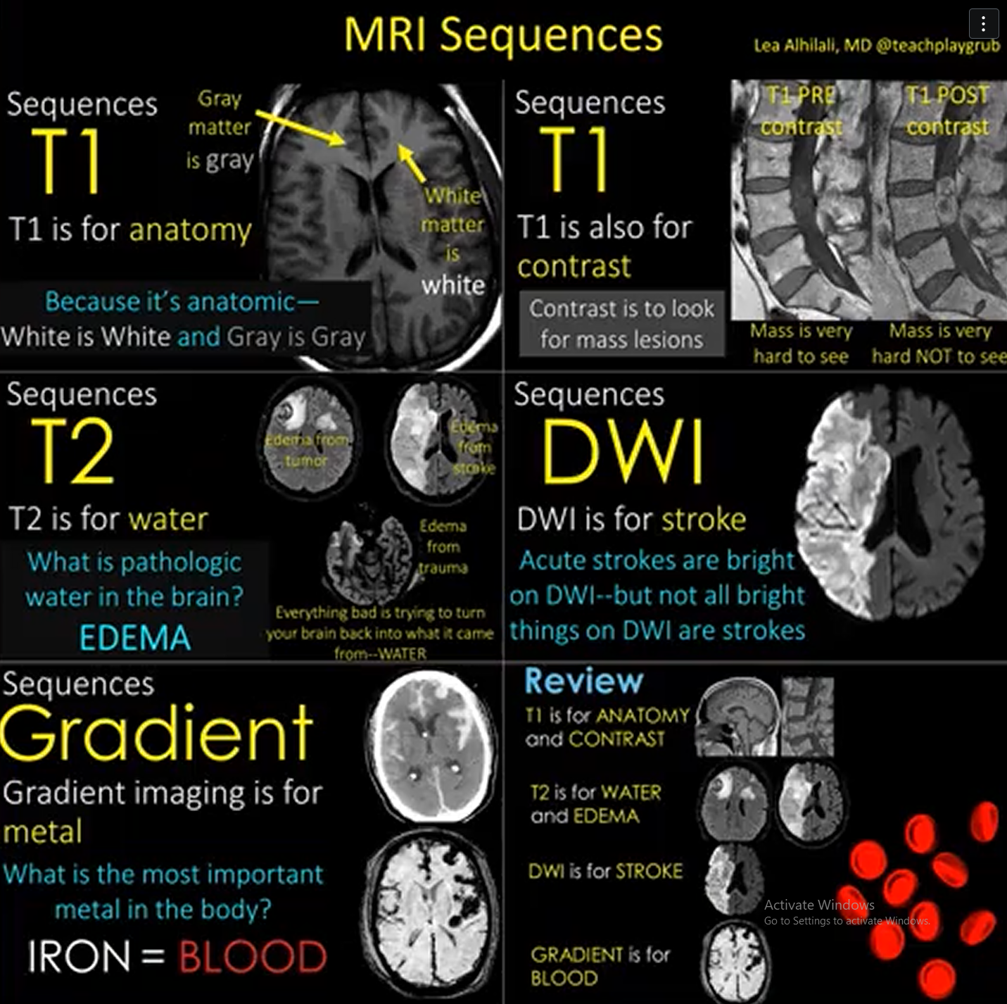 <p>Indications:</p><ul><li><p>Headssaches</p></li><li><p>Tumour</p></li><li><p>Infection</p></li><li><p>Stroke</p></li></ul><p></p><p>Sequences:</p><ul><li><p>3 plane localizer</p></li><li><p>Sagittal T1</p></li><li><p>Axial T2</p></li><li><p>Axial FLAIR</p></li><li><p>Axial DWI</p></li><li><p>Axial Gradient</p></li></ul><p></p><p>Coil: </p><ul><li><p>head coil</p></li></ul><p></p>