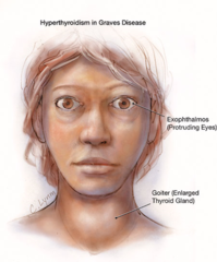<p>nervousness</p><p>increased sweating</p><p>heat intolerance</p><p>palpitations, tachycardia</p><p>fatigue, weakness</p><p>weight loss with increased appetite</p>
