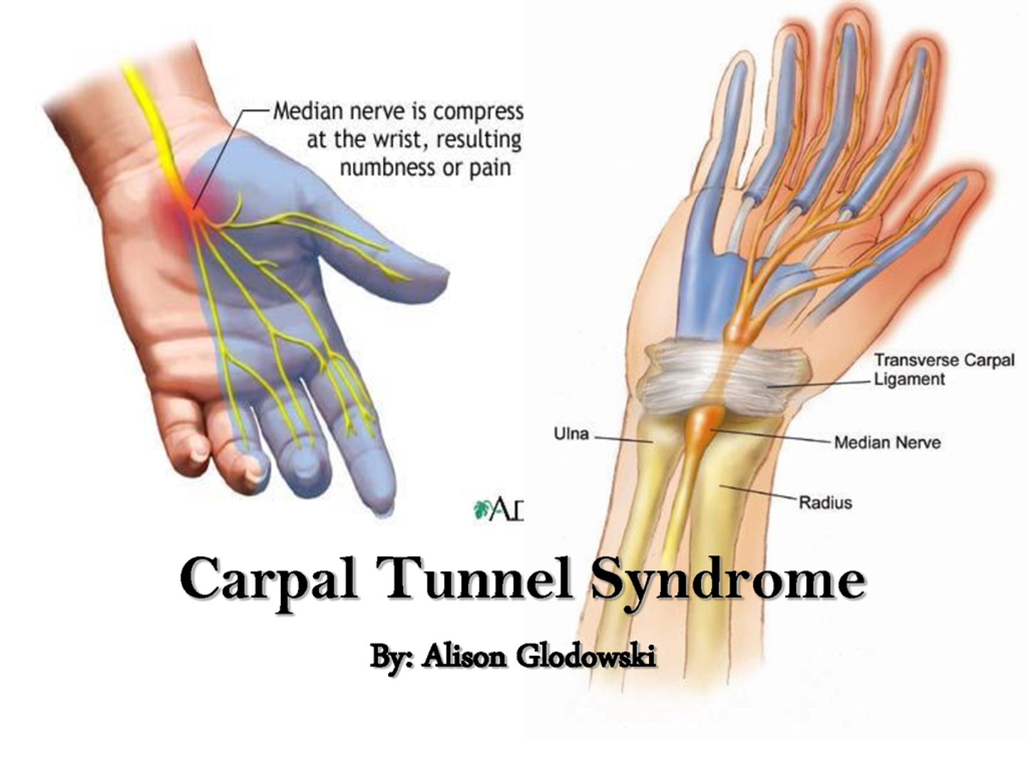 <p>Median nerve compression at the wrist causing hand symptoms.</p>