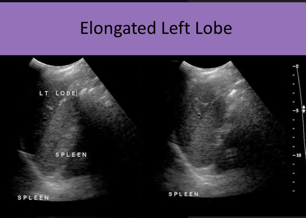 <ul><li><p>elongated left lobe that extends into the LUQ</p></li><li><p>left lobe can be seen adjacent to medial and superior spleen</p></li><li><p>left lobe extends anterolateral across AO to the LUQ</p></li><li><p>can be mistaken for hepatomegaly</p></li><li><p>normal echotexture</p></li></ul><p></p><p></p>