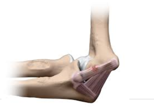 <p><span style="background-color: transparent;"><strong>What is the name of the injury shown in the picture below?</strong></span></p>