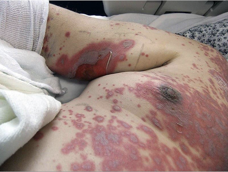 <p>skin drug reaction </p><p>skin detachment of less than 10% of body surface </p>