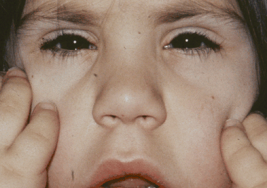 <p>Facie/patología, llamativo color amarillorrojizo, la iritis (40%), inyección conjuntival y herpe labial hemorrágico (exclusivo de esta dolencia) </p>