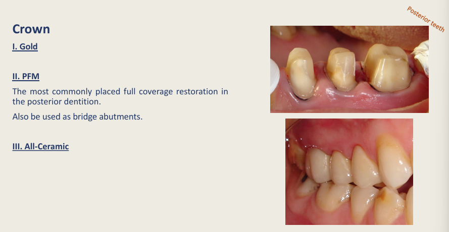 <p>Gold/PFM/All-ceramic</p>