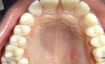 <p>situated lingually or buccally to a molar </p>