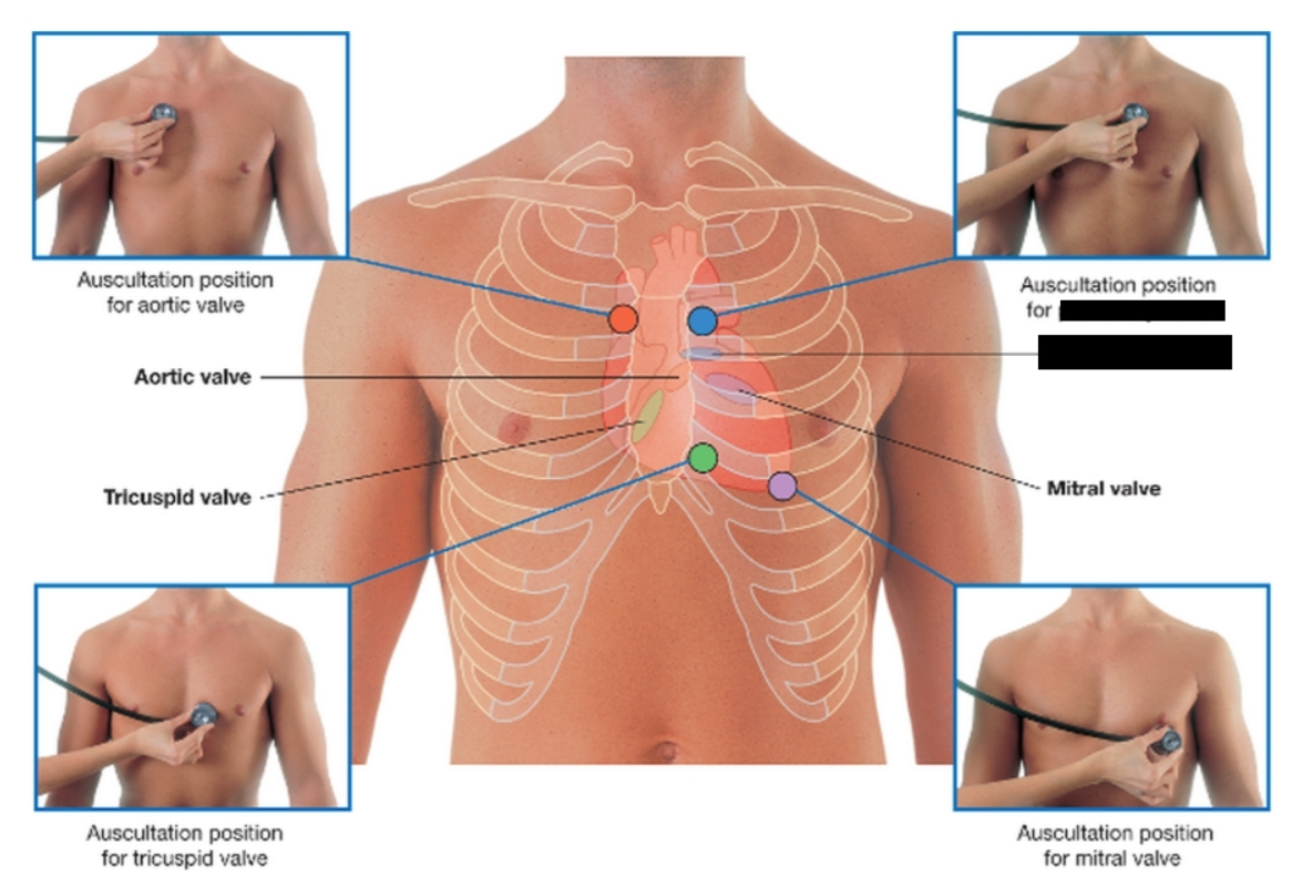 <p>a crucial one-way valve in the heart that lies between the right ventricle and the pulmonary artery. Its primary function is to allow oxygen-poor blood to flow into the lungs for reoxygenation, while snapping shut to prevent the blood from flowing backward into the heart.</p>