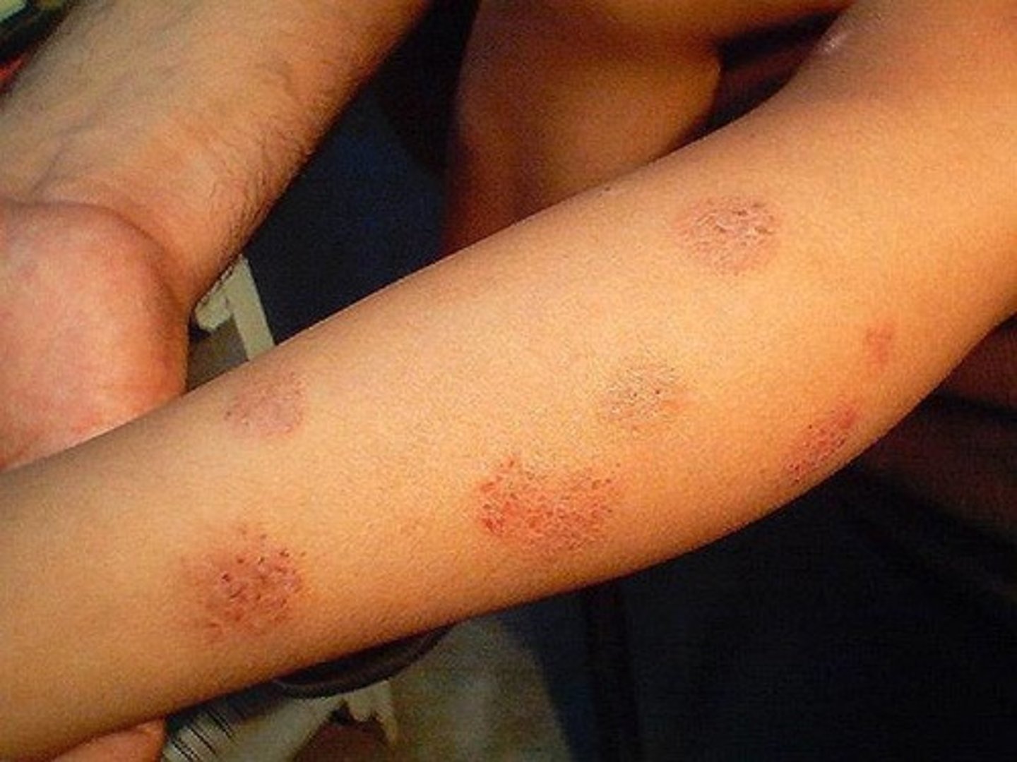 <p>- pruritic nummular erythematous scaling lesions in young adults and the elderly</p><p>- more common in winter (dry)</p><p>- more spotty than atopic dermatitis</p>