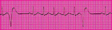 <p>Which rhythm is this?</p>