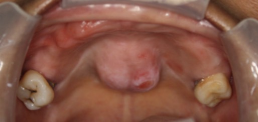 <p><span><span>What is the most likely cause for the redness on this torus?</span></span></p>