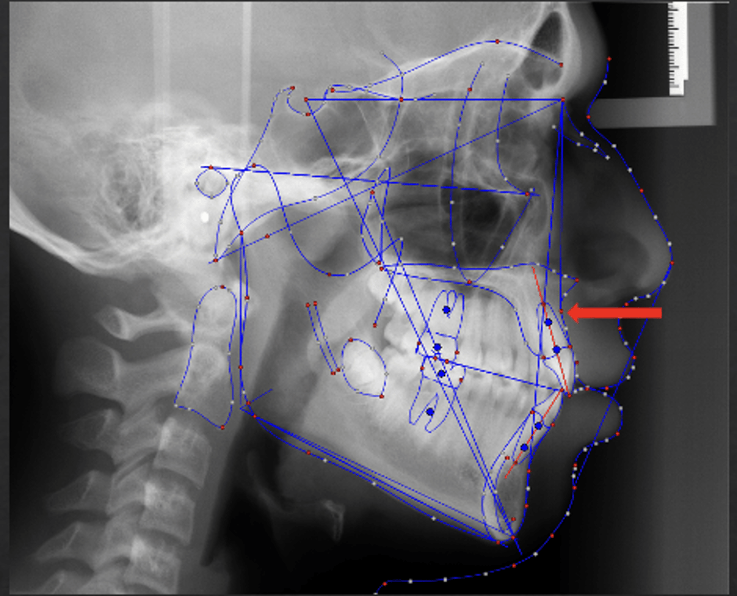 <p>which anatomical landmark:</p><p>- Deepest point of the curve of the maxilla, between anterior nasal spine (ANS) and the dental alveolus</p>