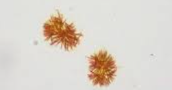 <p>Yellow/brown, fine amorphous needles</p><p>Abnormal, due to liver disease</p>