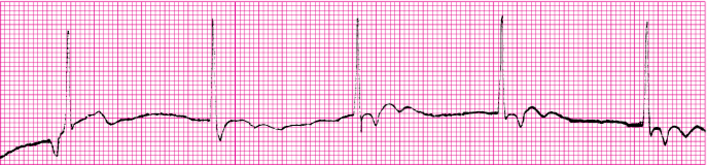 <p>What ECG is this</p>