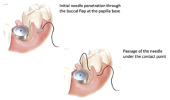 <p>To preserve papilla height; piercing is positioned apicocoronally ~3 mm apart.</p><p>(Explanation: Vertical mattress sutures align tissue vertically to maintain papilla height, critical for esthetics in areas where interdental papilla loss would be noticeable.)</p>
