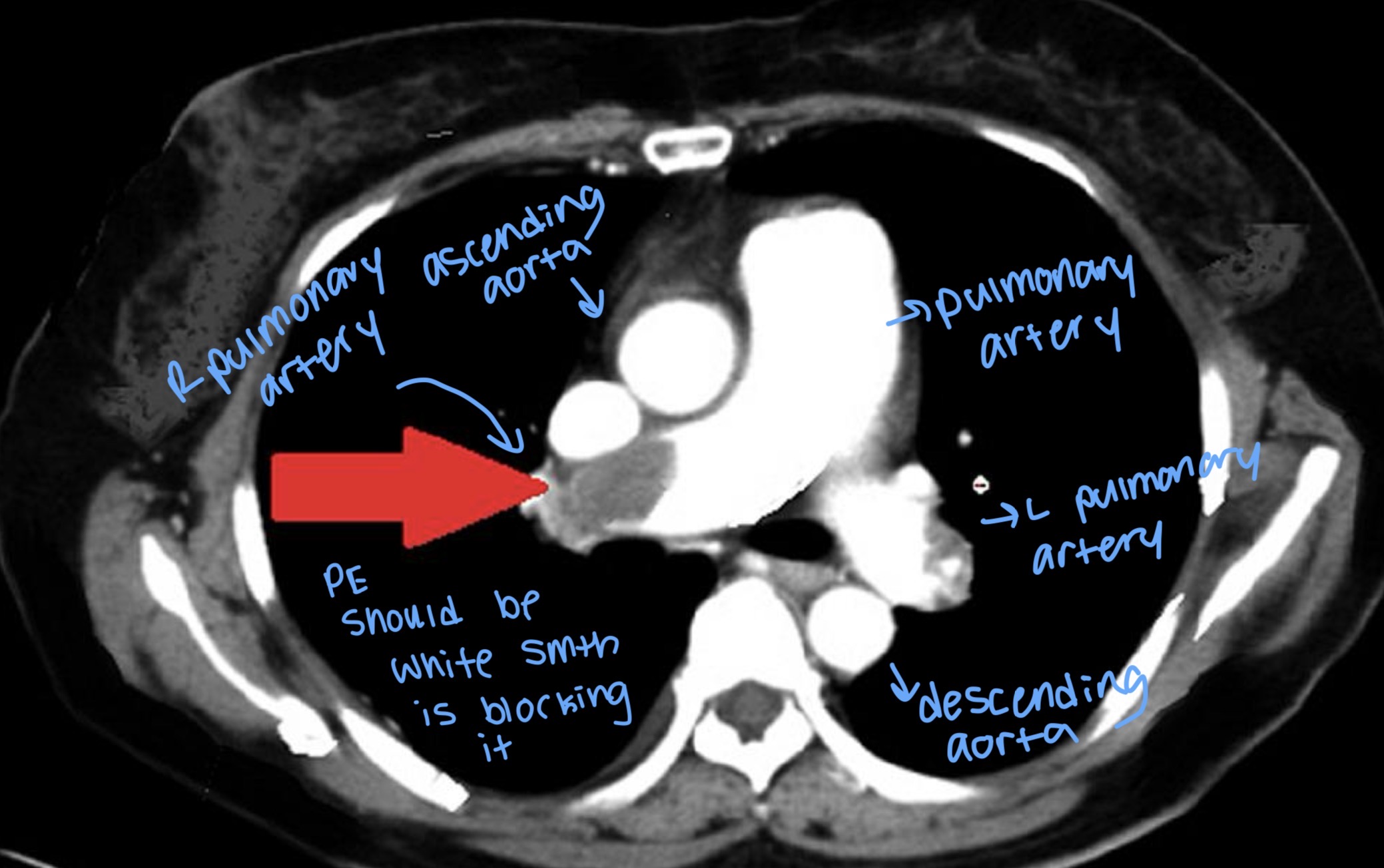 <p><span style="background-color: transparent;"><strong>The "Gold Standard":</strong> The <strong>CT Pulmonary Angiogram (CTPA)</strong> is the preferred test because it is fast and precisely shows where the clot is located.</span></p>