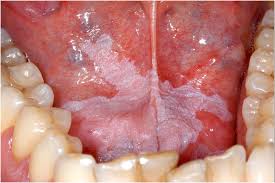 <p>What is the most likely diagnosis in that location in the oral cavity?</p>