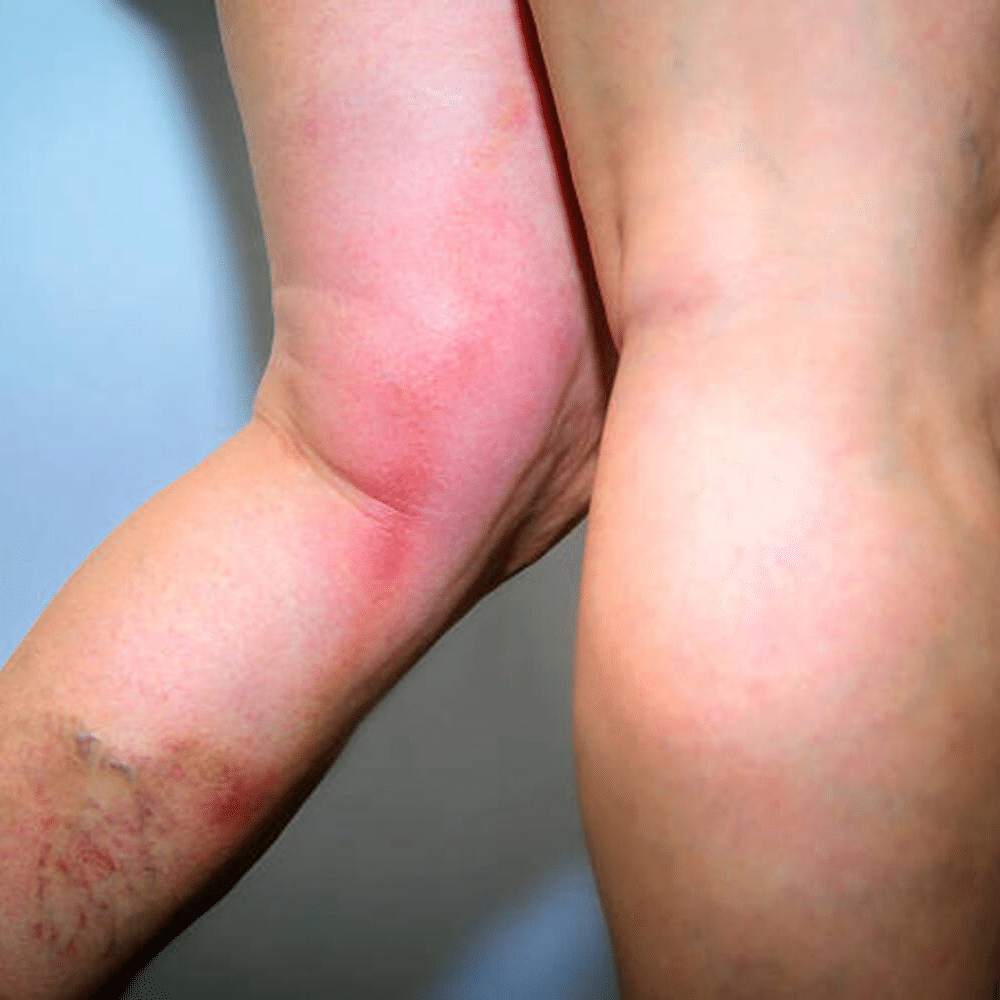 <p>Superficial venous thrombophlebitis </p>