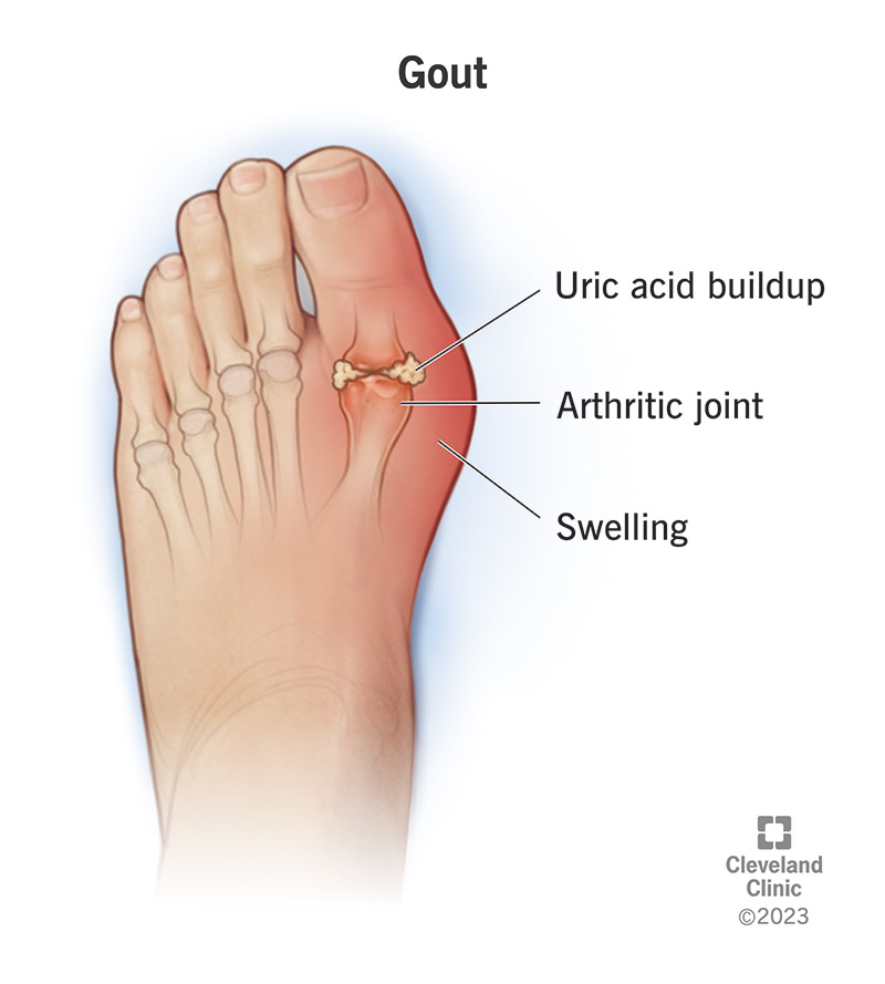 <p>develops when uric acid builds up in the blood and deposits crystals in the joints. Causes pain, swelling. </p>
