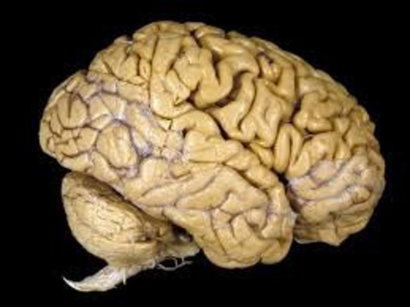 <p>An inflammation of the brain.</p>