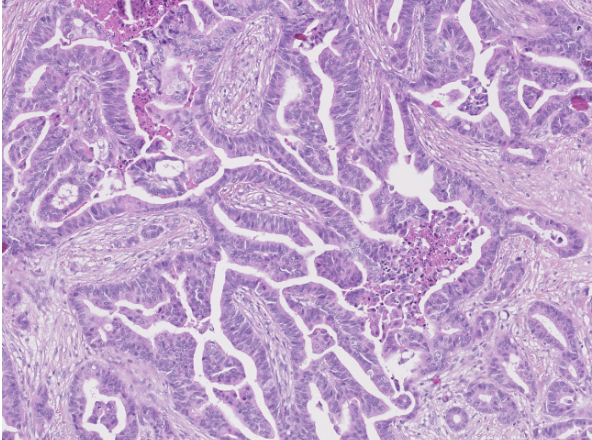 <p>1) diagnostic</p><p>2) critères</p><p>3) que faire devant cette lésion </p>