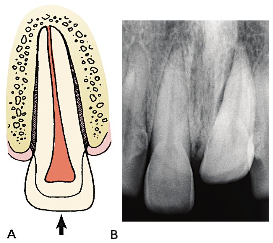 <p>socket sustains a <span style="color: red;">compression fracture</span>, causing the tooth to be displaced into a new position</p><ul><li><p>for <span style="color: red;">permanent</span> teeth:</p><ul><li><p><span style="color: red;">minimal</span> intrusion → allow the tooth to <span style="color: red;">re-erupt spontaneously</span></p></li><li><p><span style="color: red;">severe</span> intrusion → <span style="color: red;"> reposition orthodontically</span> or surgically</p></li></ul></li><li><p>for <span style="color: red;">primary</span> teeth:</p><ul><li><p>if the tooth <span style="color: red;">touches</span> the permanent tooth follicle →<span style="color: red;"> remove the deciduou</span>s tooth atraumatically</p></li><li><p>if it does <span style="color: red;">not</span> touch the permanent tooth follicle → <span style="color: red;">observe and monitor</span> the tooth</p></li></ul></li></ul><p></p>